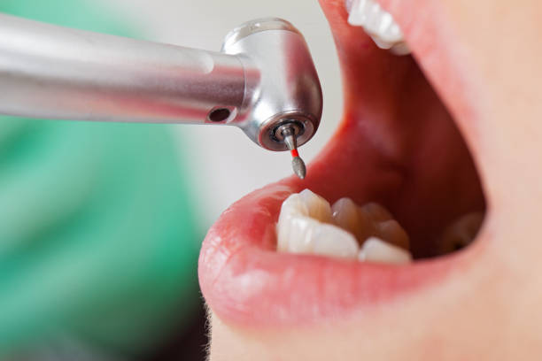 Best Broken or Chipped Tooth Repair in Harrisonville, MO